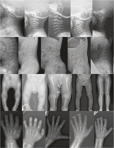 Figure 4: Radiographs depicting skeletal features of individuals with Saul–Wilson syndrome showing the individuals with growth deformities. Image available at the original source: https://doi.org/10.1038/s41436-019-0737-14.