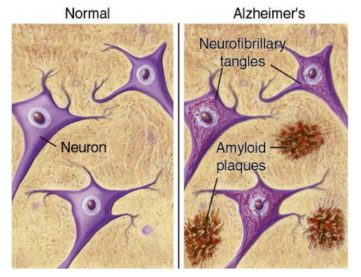 ormal brain vs. brain affected by AD: showing the hallmarks of the disease (Wyatt Technology, n.d.).
